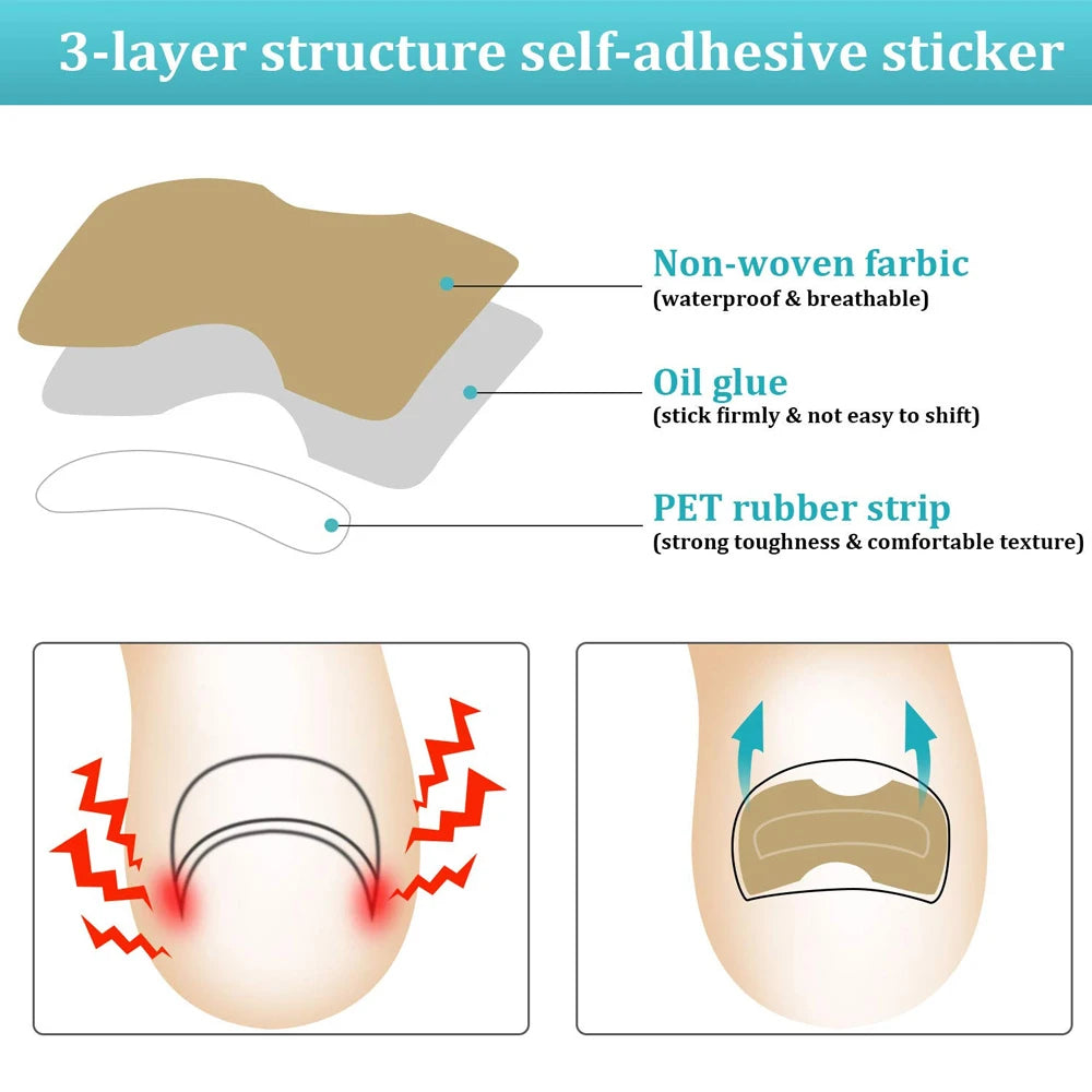 Kit Para Correção De Unha Encravadas Com Adesivos.